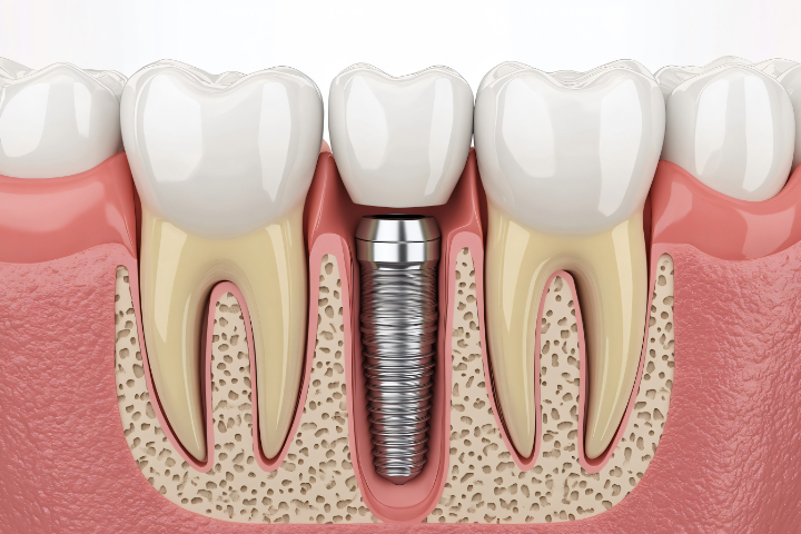インプラントの治療は難しいのか説明するイメージ