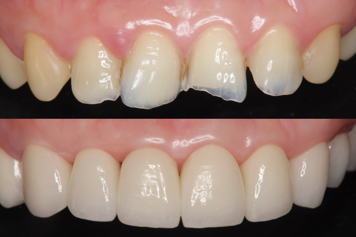 欠けた歯をセラミック治療した前後のイメージ