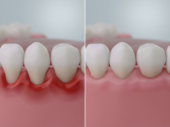 重度の歯周病の状態