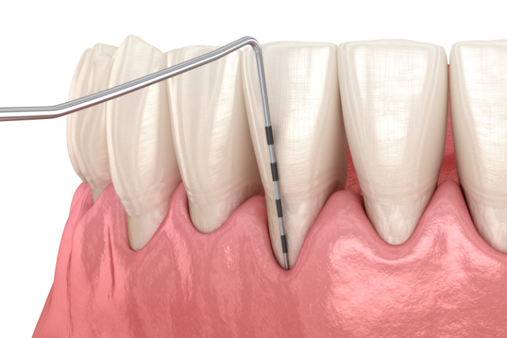 重度の歯周病の歯周ポケットを検査する様子