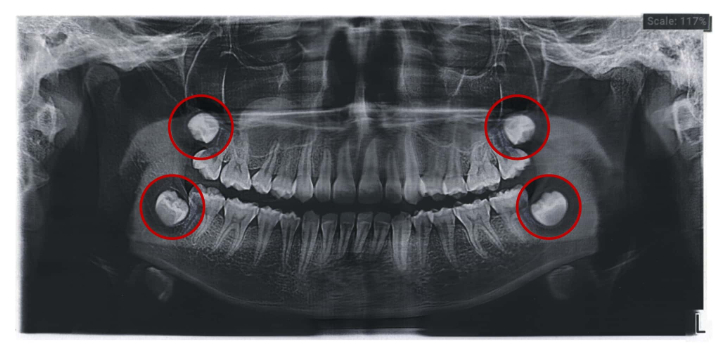 4本の親知らずが写ったレントゲン写真