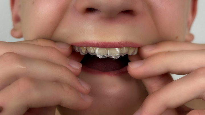 インビザライン・ファーストを装着している子ども