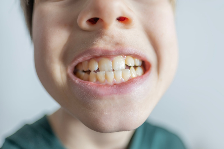 歯ならびの悪い子どもの口もとのイメージ